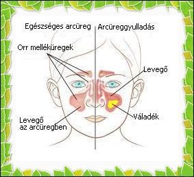 Sinusitis maxillaris - Arcüreggyulladás